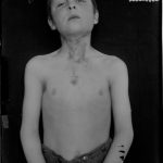 Black and white photograph of a young boy with bare torso showing scarring to neck and chest from tuberculosis infection