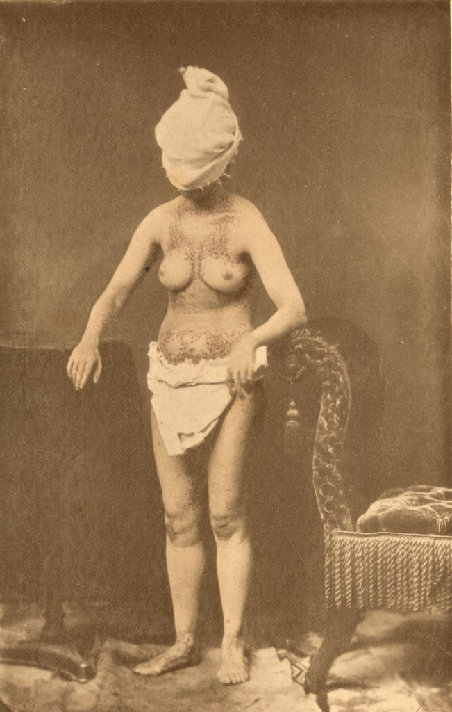 Amateur black and white photograph of a young adult woman with bare torso showing scarring from tuberculosis infection wearing a towel as a hood to cover the face
