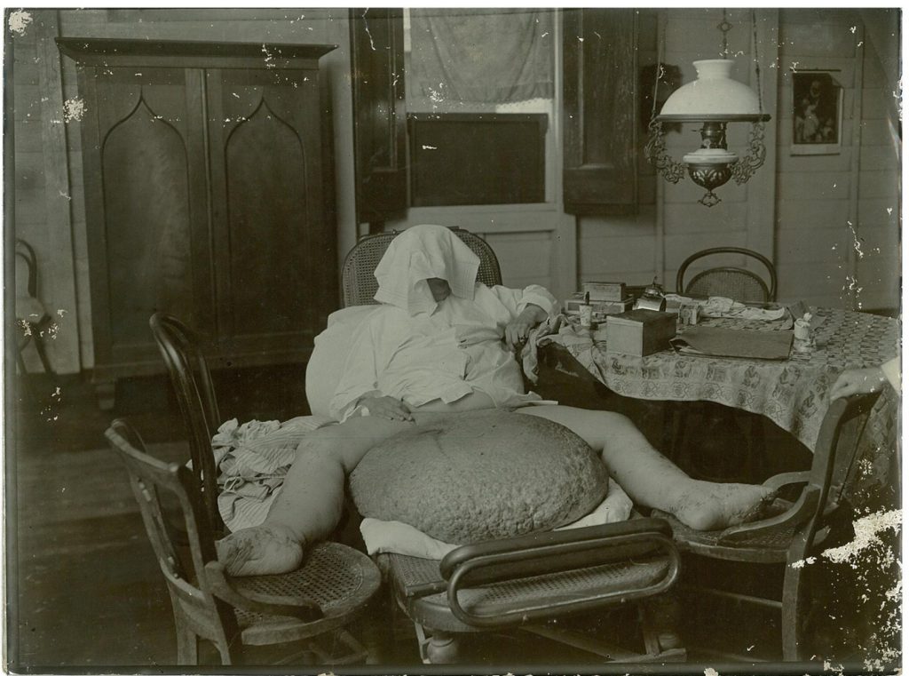 Black and white photograph of an adult male showing elephantiasis of the scrotum wearing a towel as a hood to cover the face