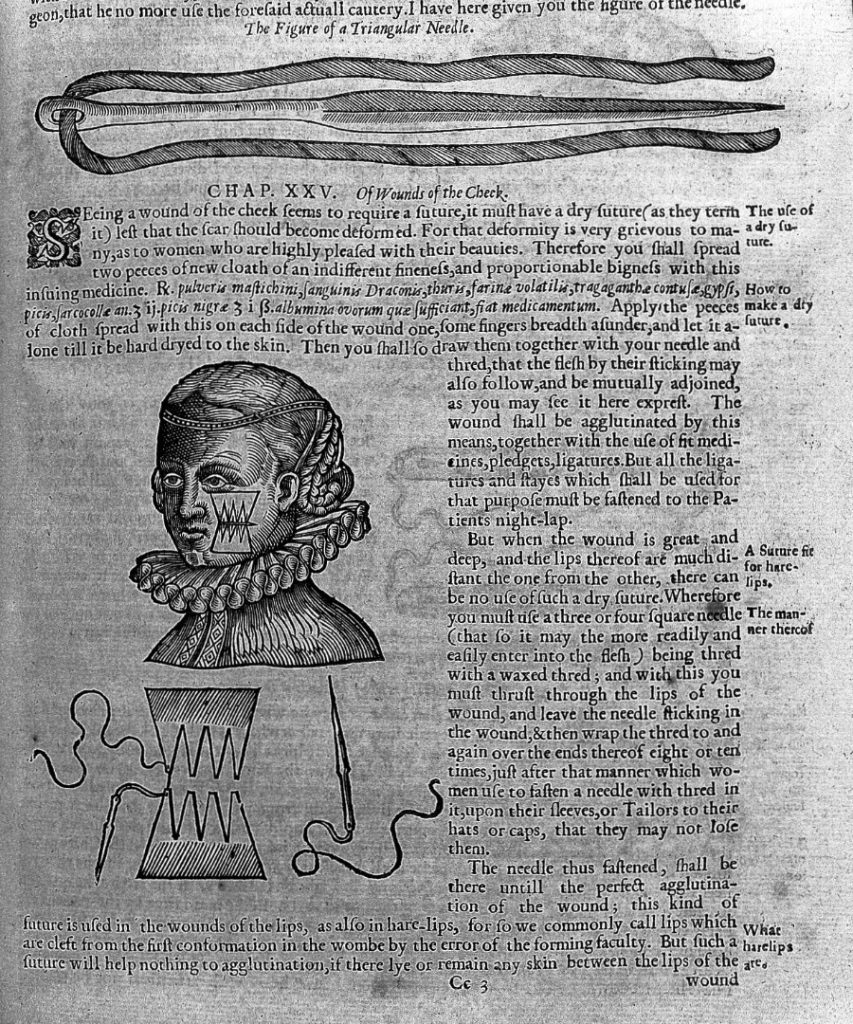 Page from an eighteenth century book on wound surgery