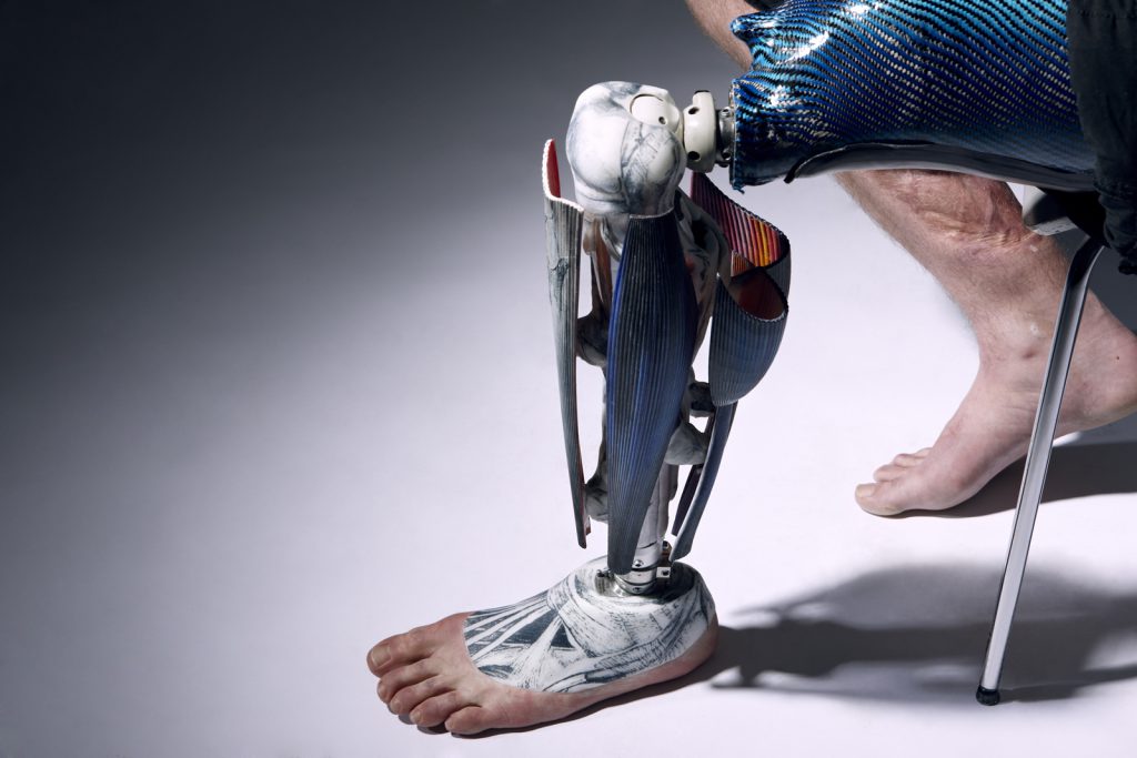 Colour photograph of a 3D printed nylon prosthetic leg as worn by an amputee