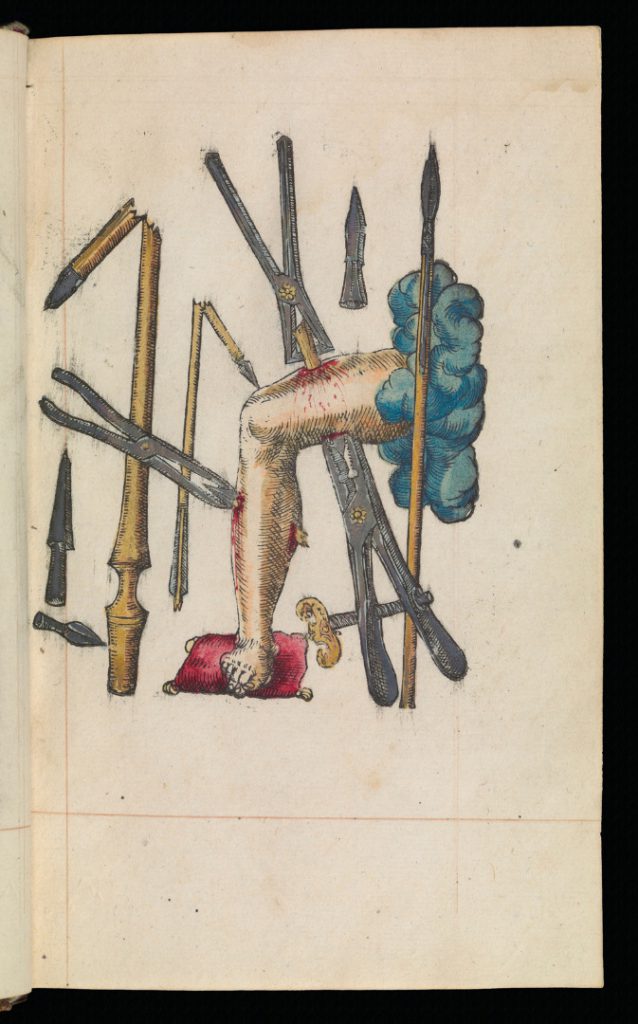 Book illustration showing typical war wounds and treatment from 1628