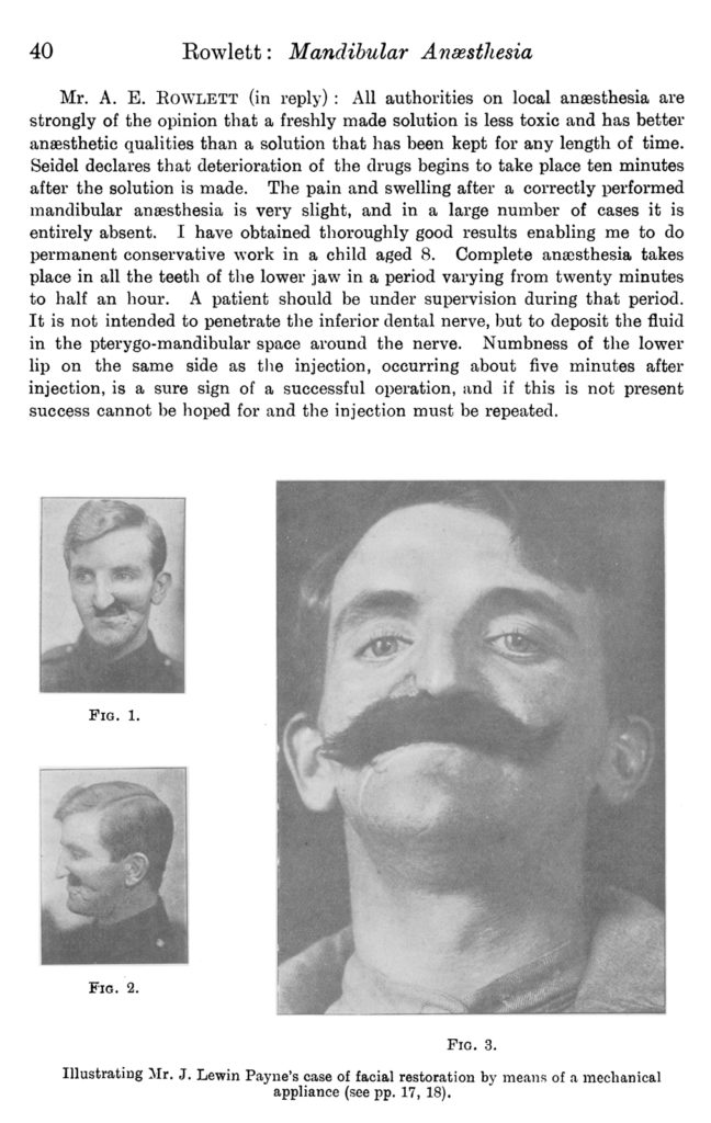Page from a 1916 journal showing photographs of facial restoration by means of mechanical appliance