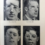 Page from a 1918 book showing soldiers who have sustained significant facial injuries