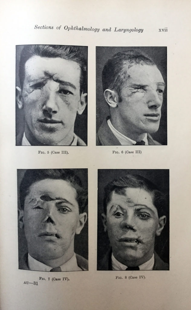Page from a 1918 book showing soldiers who have sustained significant facial injuries