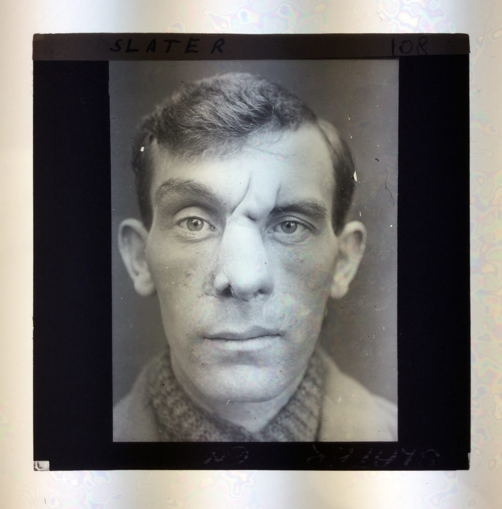 A photographic lantern slide from 1918 showing a soldier following reconstructive facial surgery
