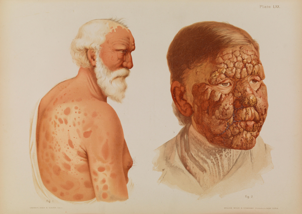 Watercolour painted portraits of two patients with leprosy