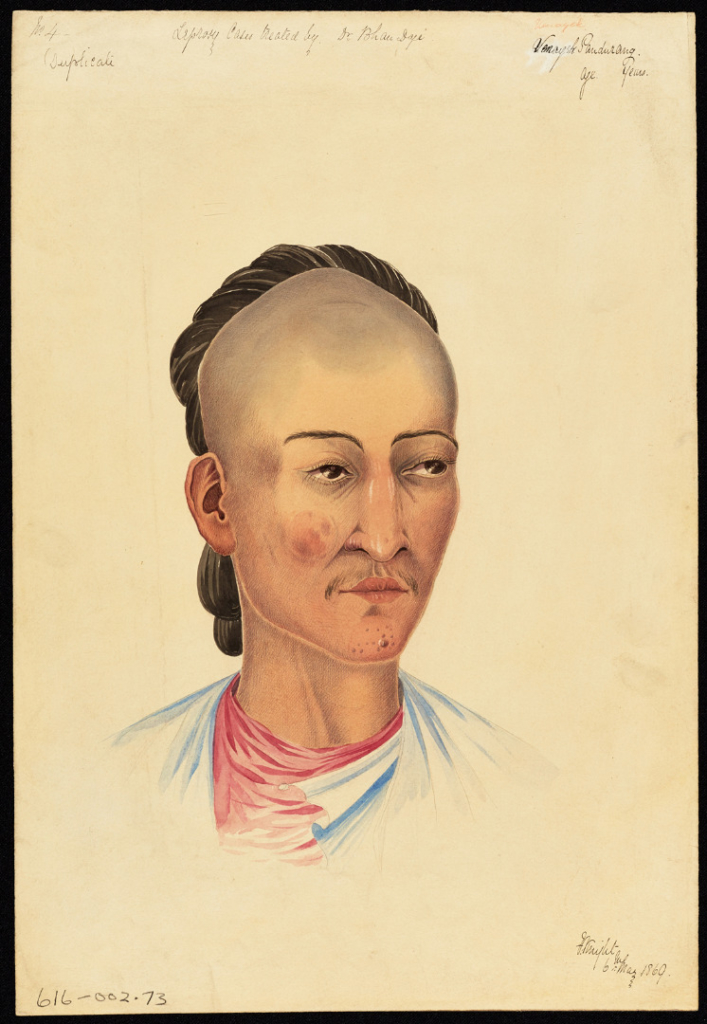 Watercolour portrait of a patient with leprosy