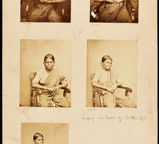 Set of sepia photographs of an Indian female leprosy patient