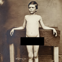 Four black and white photographs of a European young male leprosy patient