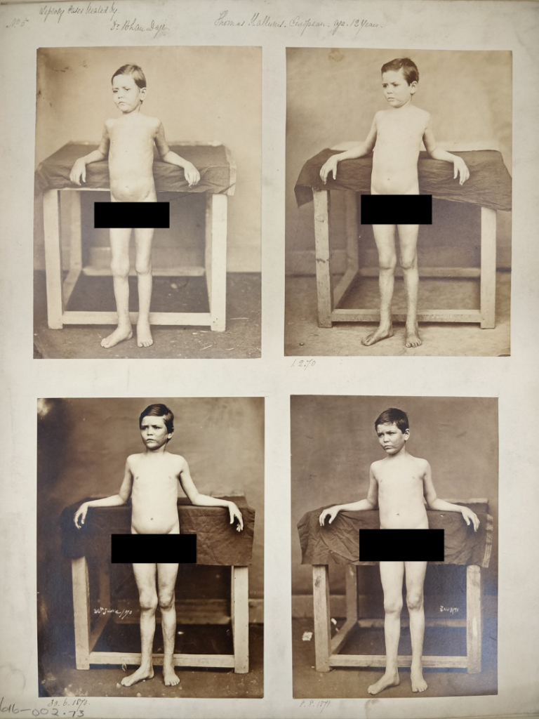 Four black and white photographs of a European young male leprosy patient