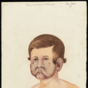 Watercolour portrait of a male patient with leprosy