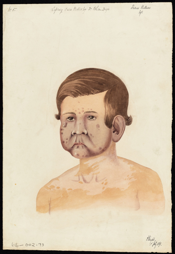 Watercolour portrait of a male patient with leprosy