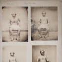 Four black and white photographs of an Indian male leprosy patient