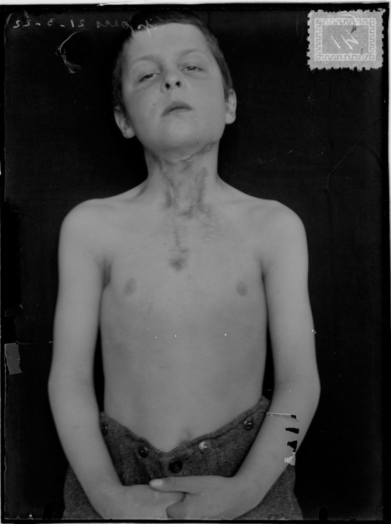 Black and white photograph of a young boy with bare torso showing scarring to neck and chest from tuberculosis infection