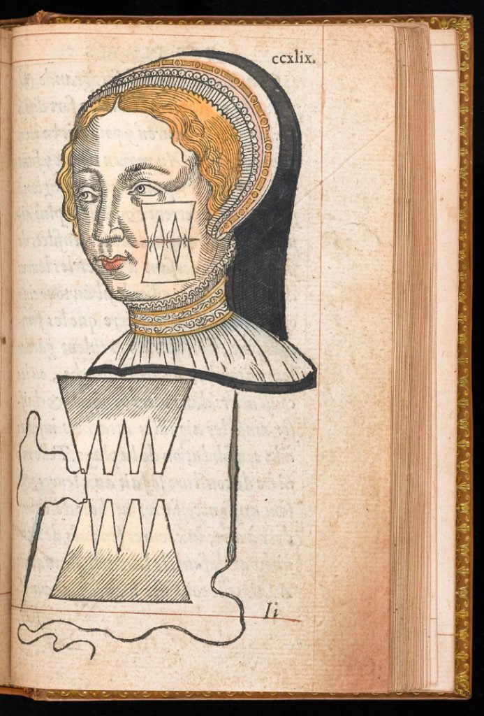 Hand-coloured illustration of facial surgery and suturing technique