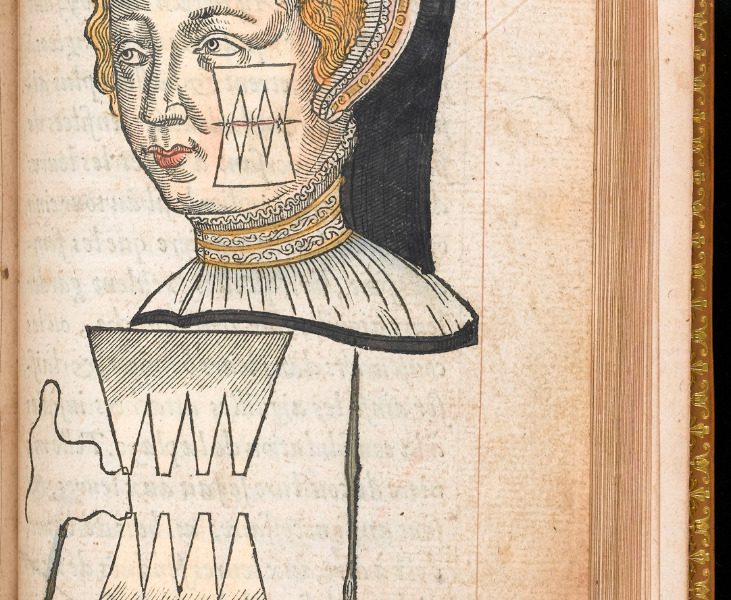 Hand-coloured illustration of facial surgery and suturing technique