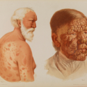 Watercolour painted portraits of two patients with leprosy