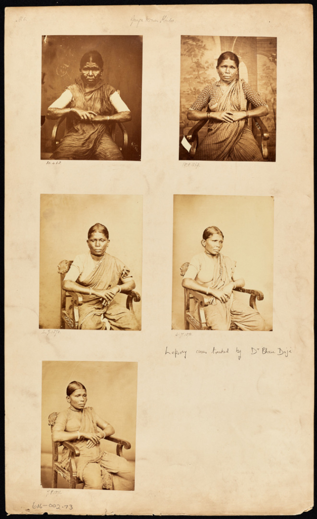Set of sepia photographs of an Indian female leprosy patient
