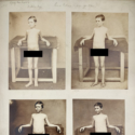 Four black and white photographs of a European young male leprosy patient