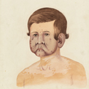 Watercolour portrait of a male patient with leprosy