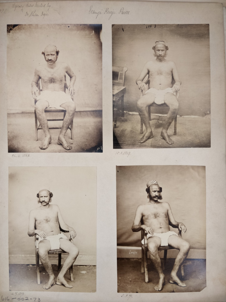 Four black and white photographs of an Indian male leprosy patient