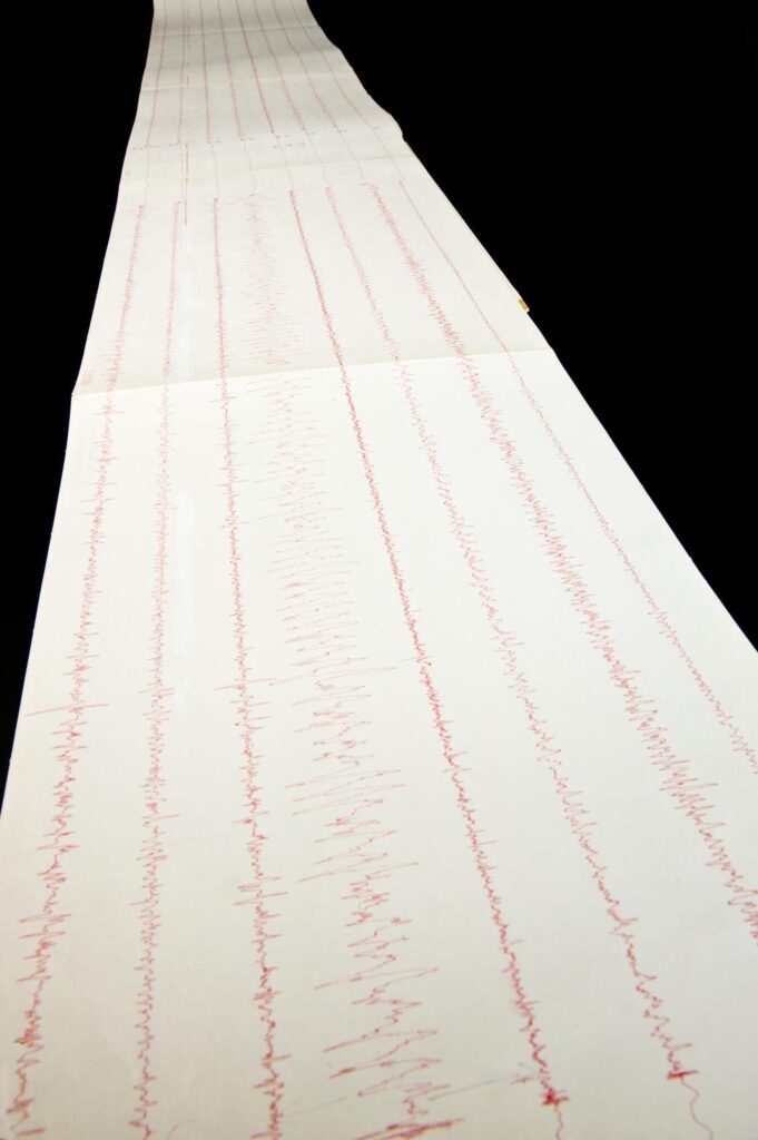 Colour photograph of the first intracerebral EEG taken from an epileptic patient